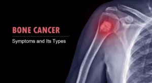Read more about the article Bone Cancer Symptoms and Types