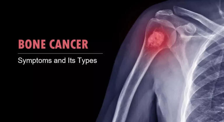 Read more about the article Bone Cancer: Symptoms and Types