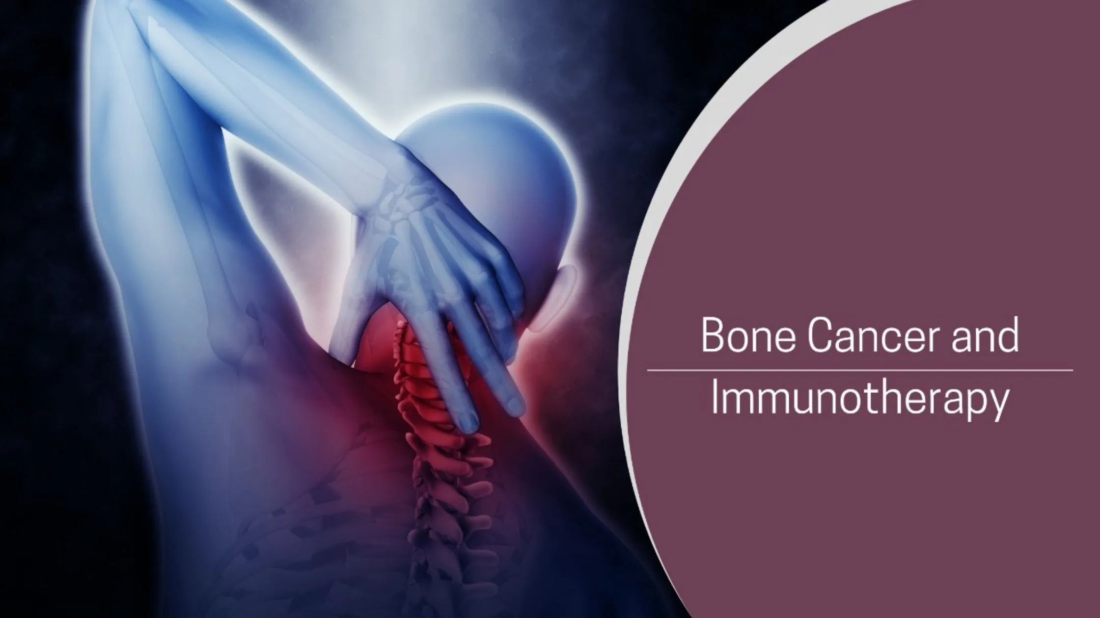 Read more about the article Bone Cancer and Immunotherapy