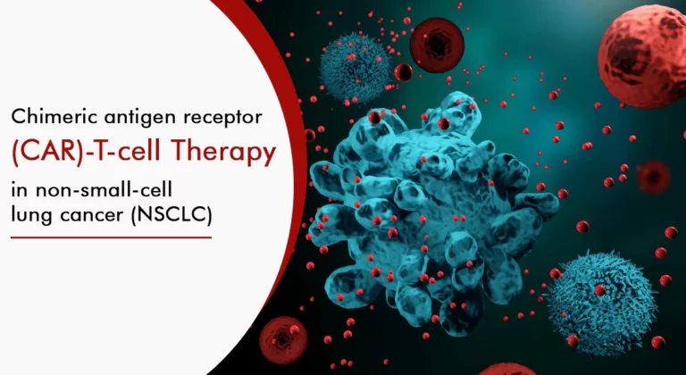 Read more about the article Chimeric antigen receptor (CAR)-T-cell therapy in non-small-cell lung cancer (NSCLC):