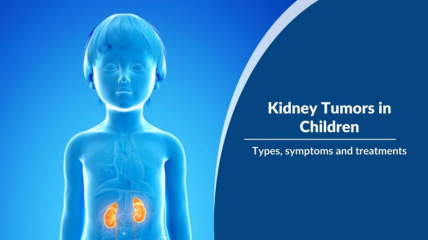 You are currently viewing Kidney Tumors in Children, types, symptoms and treatments