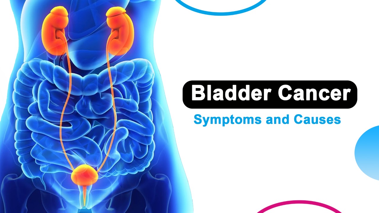 You are currently viewing What are the Symptoms and Causes of Bladder Cancer?