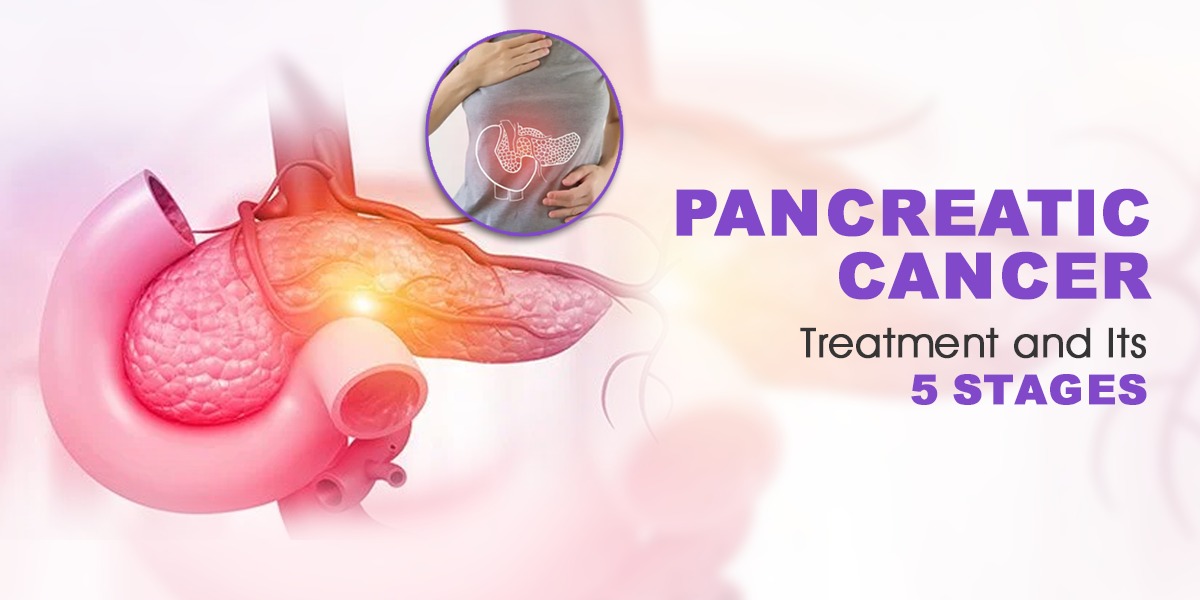 Read more about the article Pancreatic Cancer Treatment and Its 5 Stages