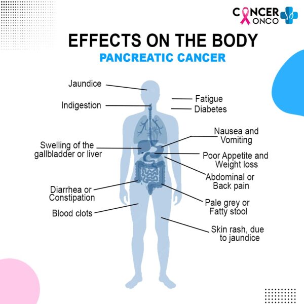 pancreatic-cancer-treatment-and-its-5-stages