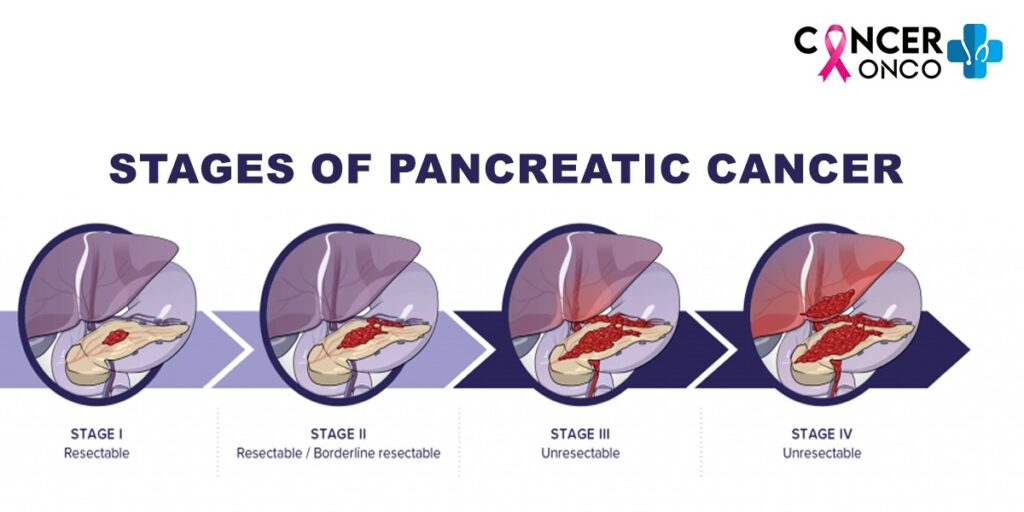 pancreatic-cancer-treatment-and-its-5-stages