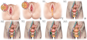 Stages of Vulvar cancer (Vulvar cancer staging)