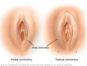 Vulvar cancer treatment options: